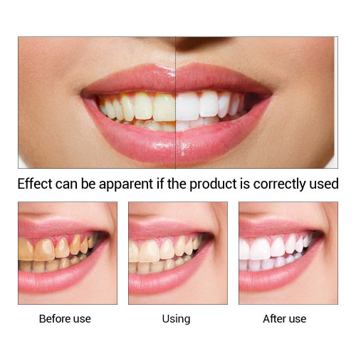 Teeth Whitening Dental Plaque Cleaning Solution